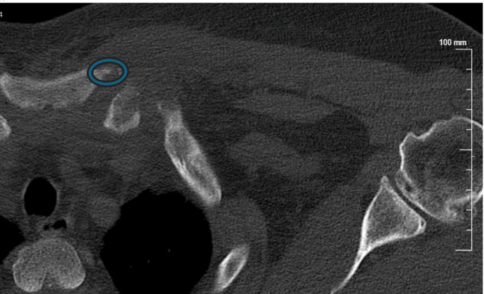 Sternoclavicular Joint Septic Arthritis Following Blunt Trauma: Successful Surgical Management and One-Year Outcome