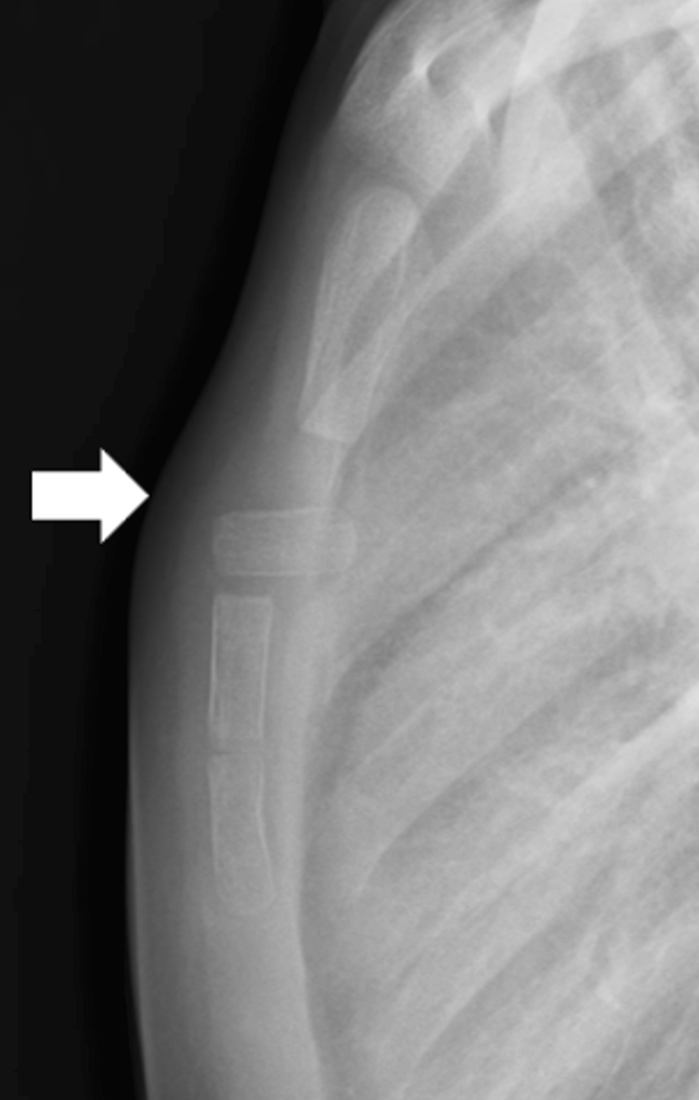 Pediatric Sternal Segment Dislocation Caused by Different Types of Injury: A Report of Two Cases