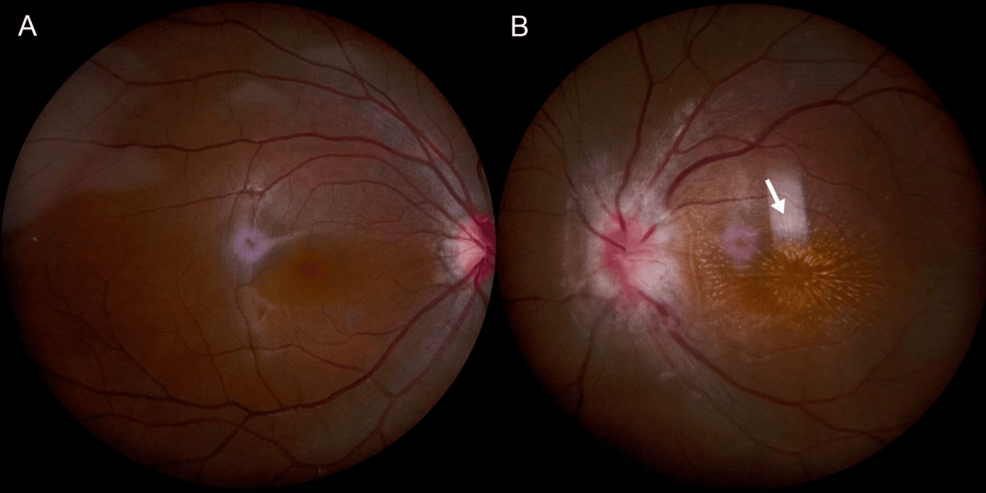Cat-Scratch Disease Presenting as Isolated Neuroretinitis (Bartonella henselae): A Case Report