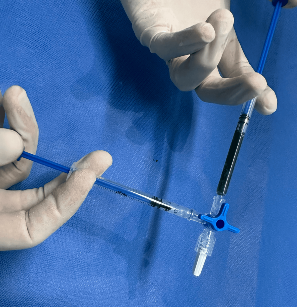 Near-Infrared Fluorescence for Precision Breast Surgery in Nonpalpable Lesions: A Case Report