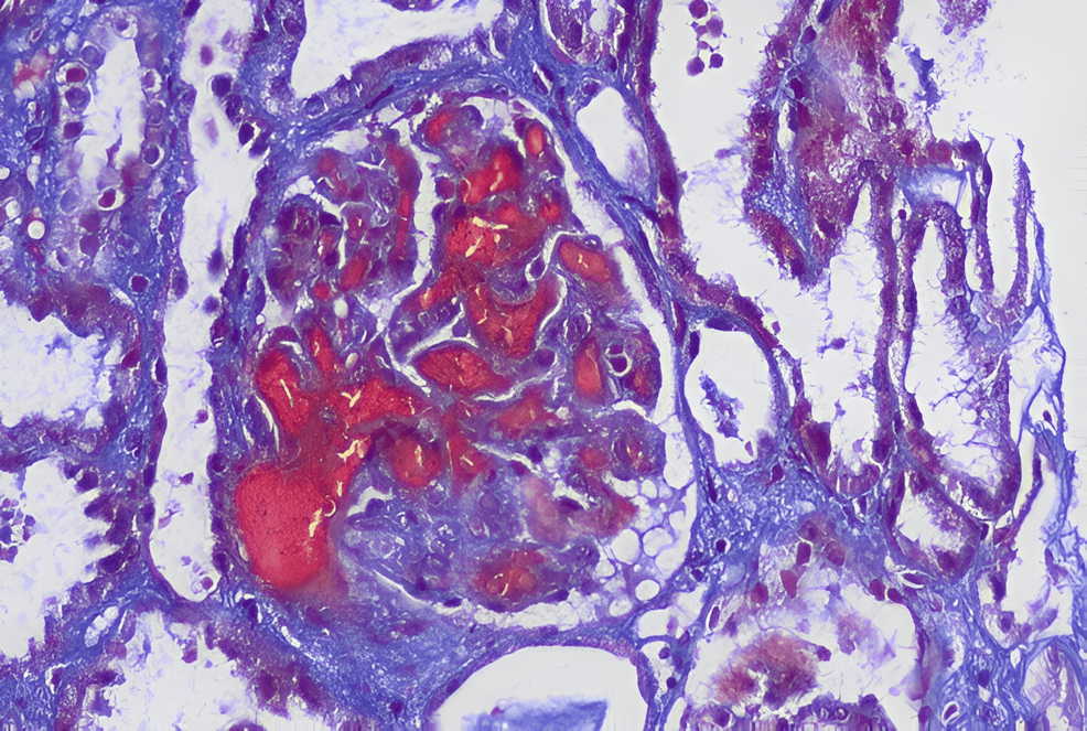 Navigating Pediatric Atypical Hemolytic Uremic Syndrome: A Two-Year Case Series From Eastern India