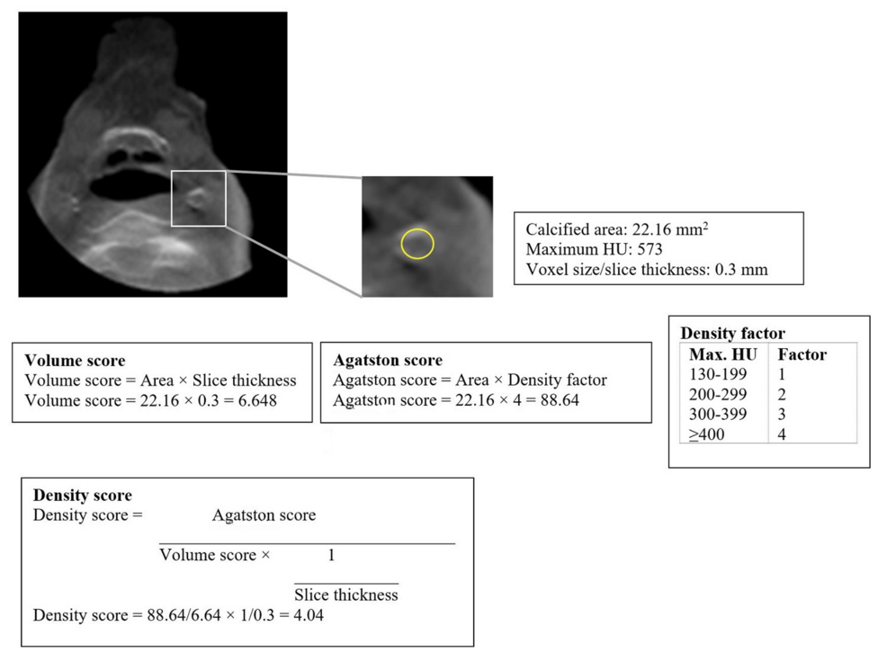 A Retrospective Pilot Study to Evaluate the Radiographic Prognosis of Calcified Carotid Atherosclerosis Based on Cone Beam Computed Tomography