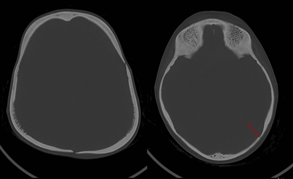 Head Trauma in Pycnodysostosis: An Imagiological Challenge