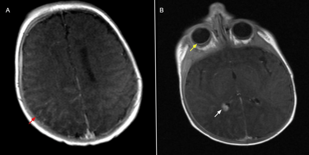Longitudinal Neuroimaging of a Pediatric Patient With Sturge–Weber Syndrome: From Birth to Adolescence