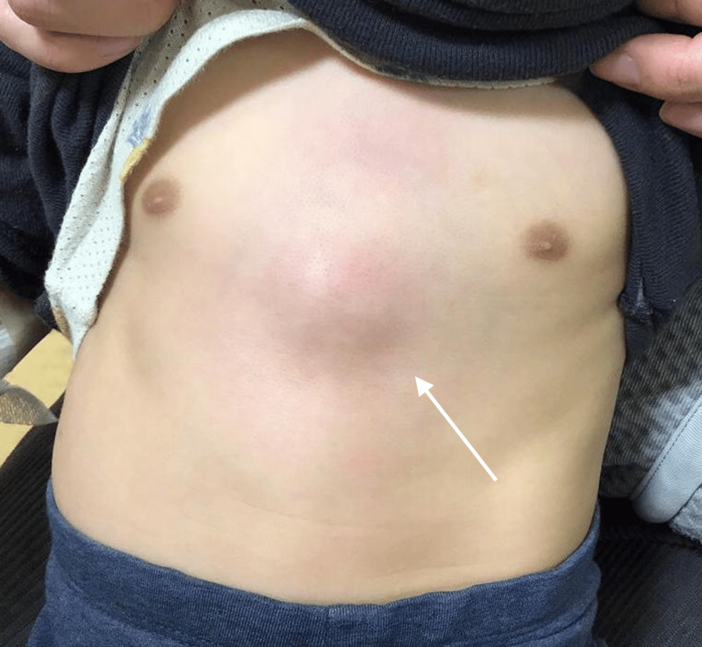 Unusual Midline Chest Wall Cellulitis in an Infant Without Trauma or Skin Barrier Disruption
