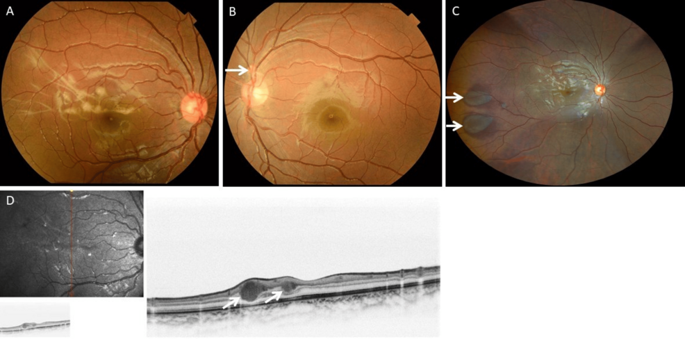 Full-Field Electroretinographic Evaluation of a Case With Benign Lobular Inner Nuclear Layer Proliferations of the Retina