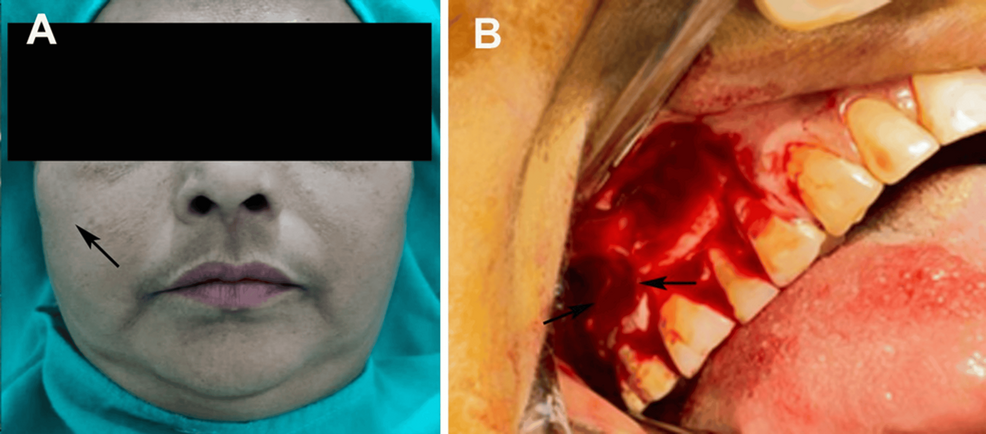 Comprehensive Management of Oroantral Fistula Secondary to Chronic Maxillary Osteomyelitis: A Case Report