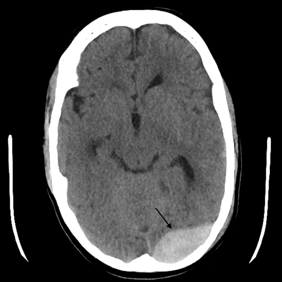 Anesthetic Μanagement of an Emergency Craniotomy in a Patient With Noonan Syndrome: A Case Report