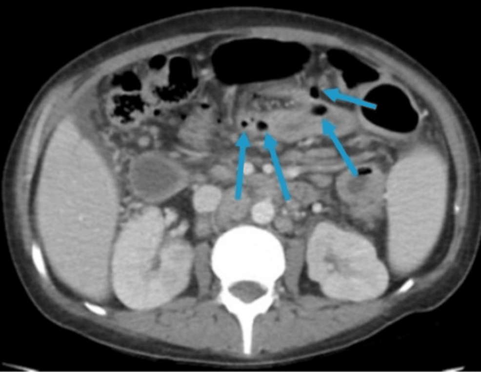 Multiple Small Bowel and Colonic Perforations Secondary to Cytomegalovirus Infection in a Newly Diagnosed AIDS Patient
