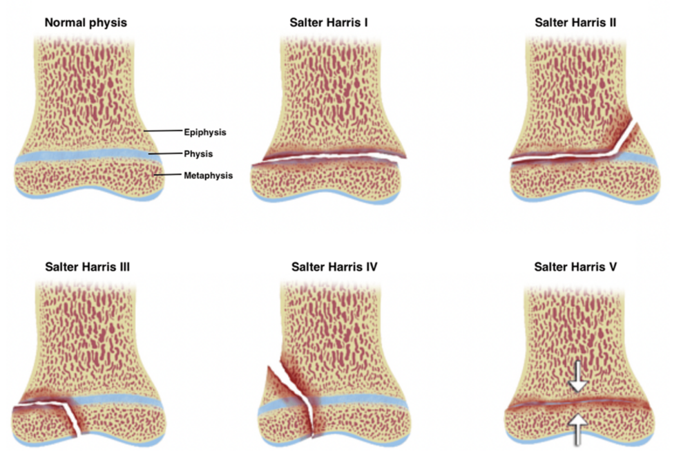 Arthroscopic-Assisted Pediatric Transitional Ankle Fracture Reduction and Fixation Technique