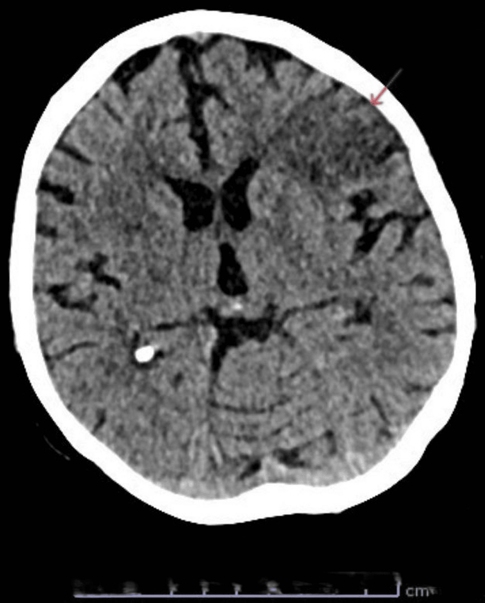 An Unusual Vascular Catastrophe: Atheromatous Aortic Dissection With Renal Artery Thrombosis and Cortical Laminar Necrosis Post Cerebral Ischemia