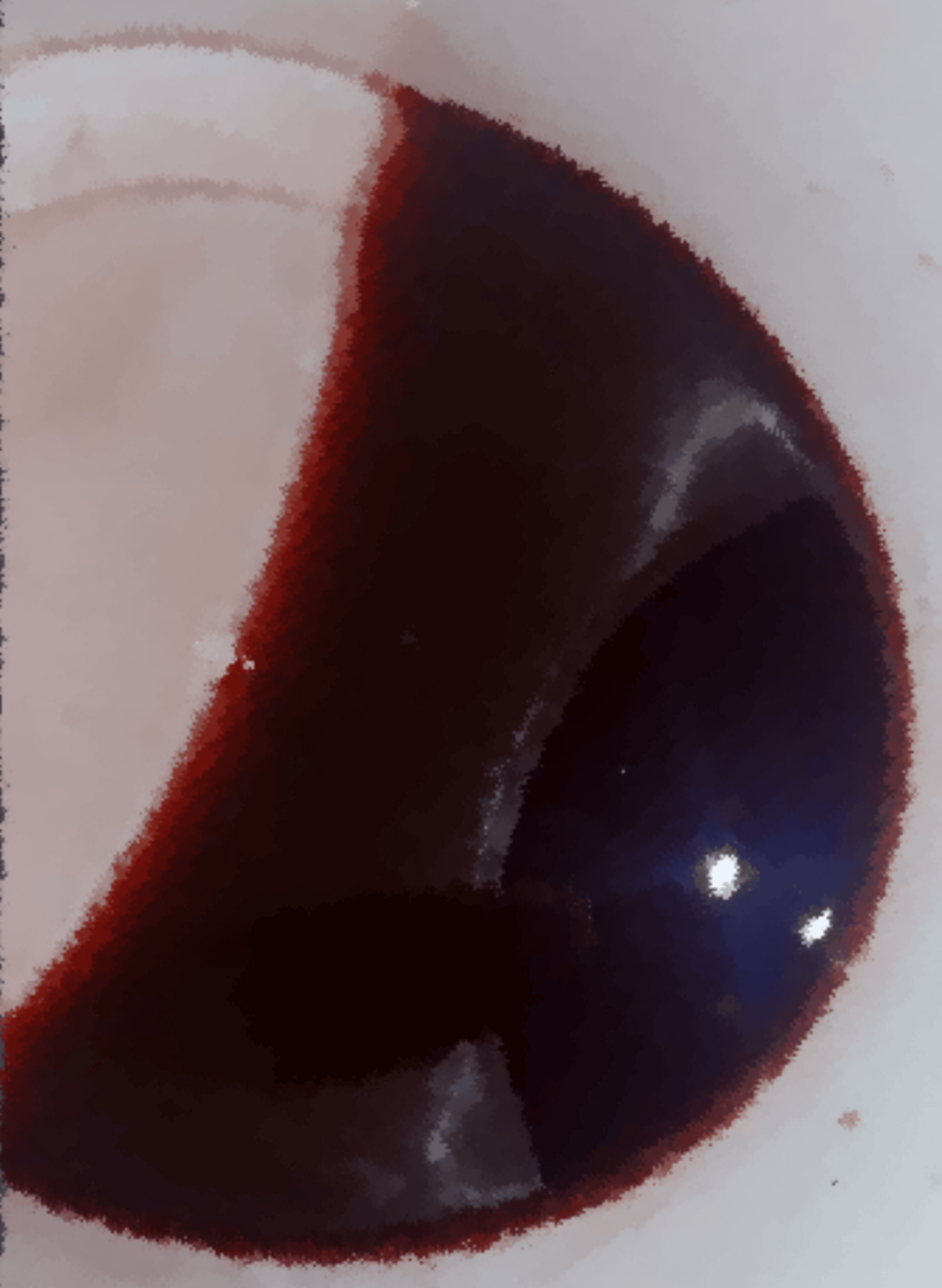 Unmasking Dual Vascular Complications of Sunitinib in Advanced Renal Cell Carcinoma