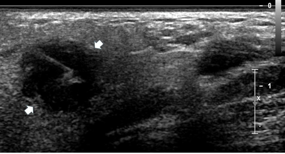 Low-Grade Mucoepidermoid Carcinoma of the Parotid in a Pediatric Survivor of Hodgkin’s Lymphoma