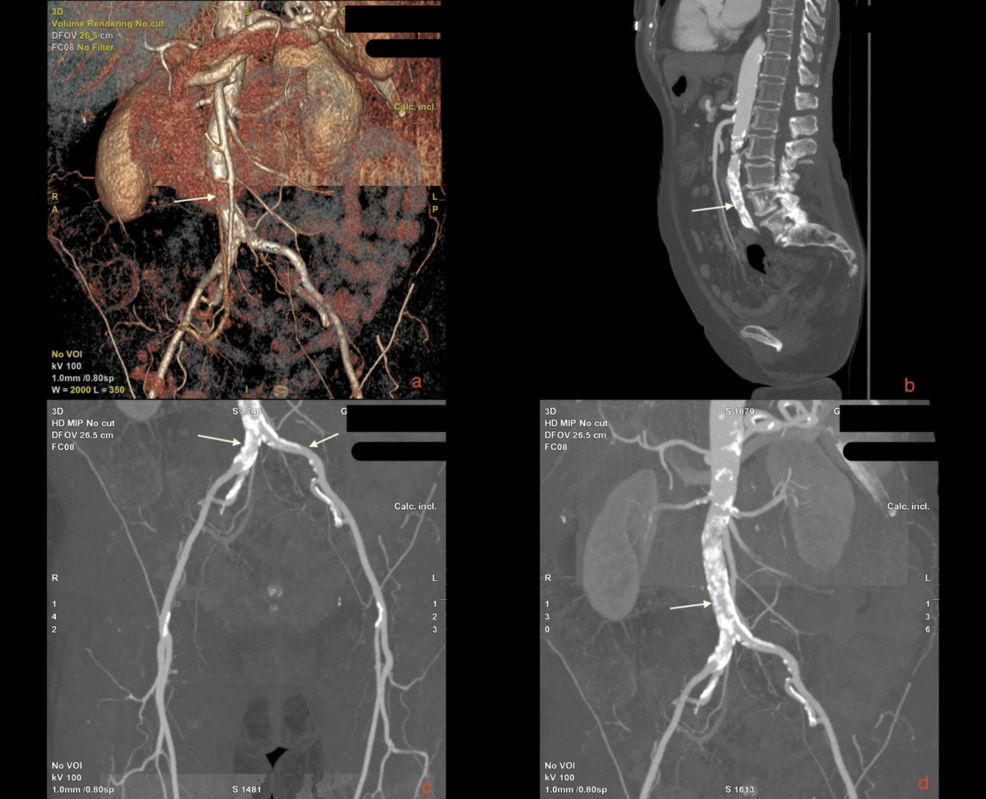 Endovascular Management of Leriche Syndrome in a 76-Year-Old Woman: A Case Report