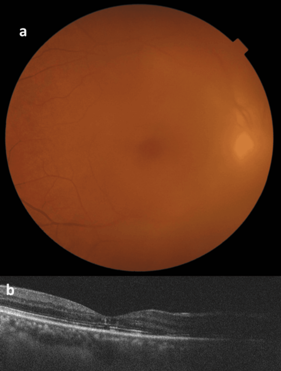 Early Pars Plana Vitrectomy and Anti-vascular Endothelial Growth Factor (VEGF) in the Management of Terson Syndrome: A Case Linked to Methicillin-Resistant Staphylococcus aureus (MRSA) Meningitis