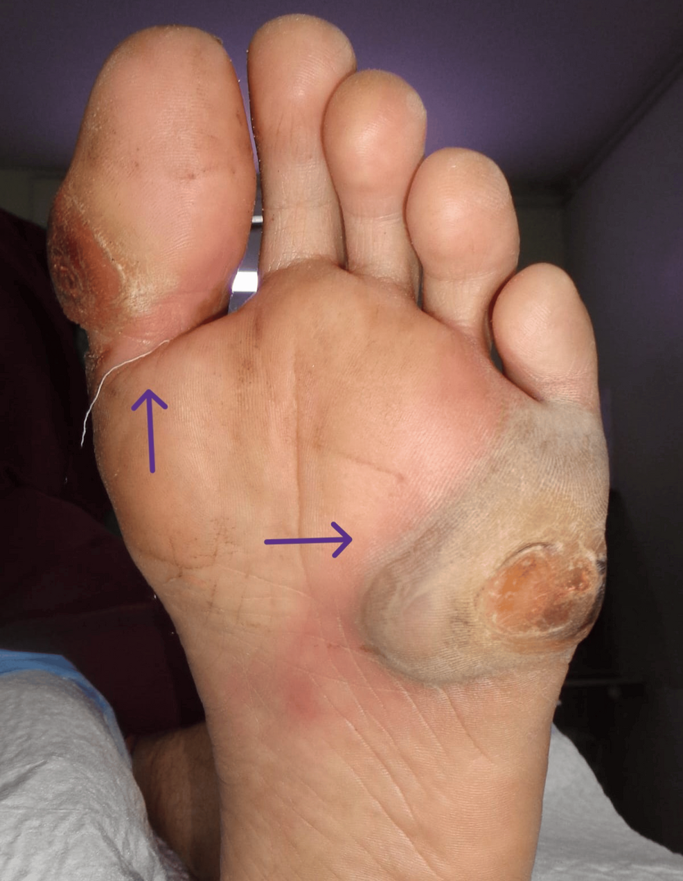 Maturity-Onset Diabetes of the Young (MODY) Presenting With a Diabetic Foot Ulcer: A Case Report
