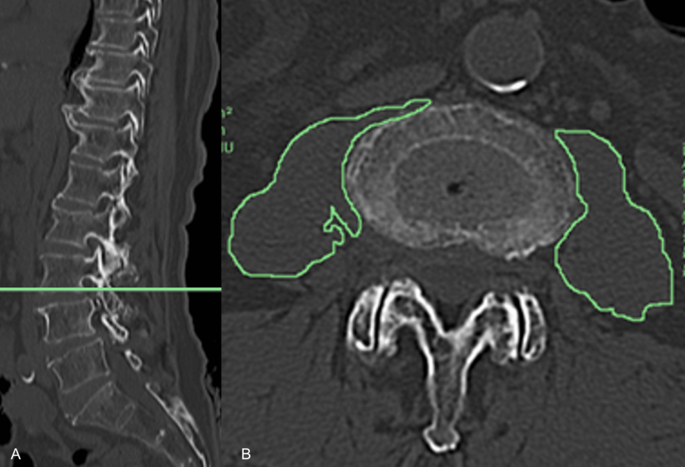 Factors Affecting Hospital Stay Duration in the Conservative Treatment of Patients With Osteoporotic Vertebral Fractures
