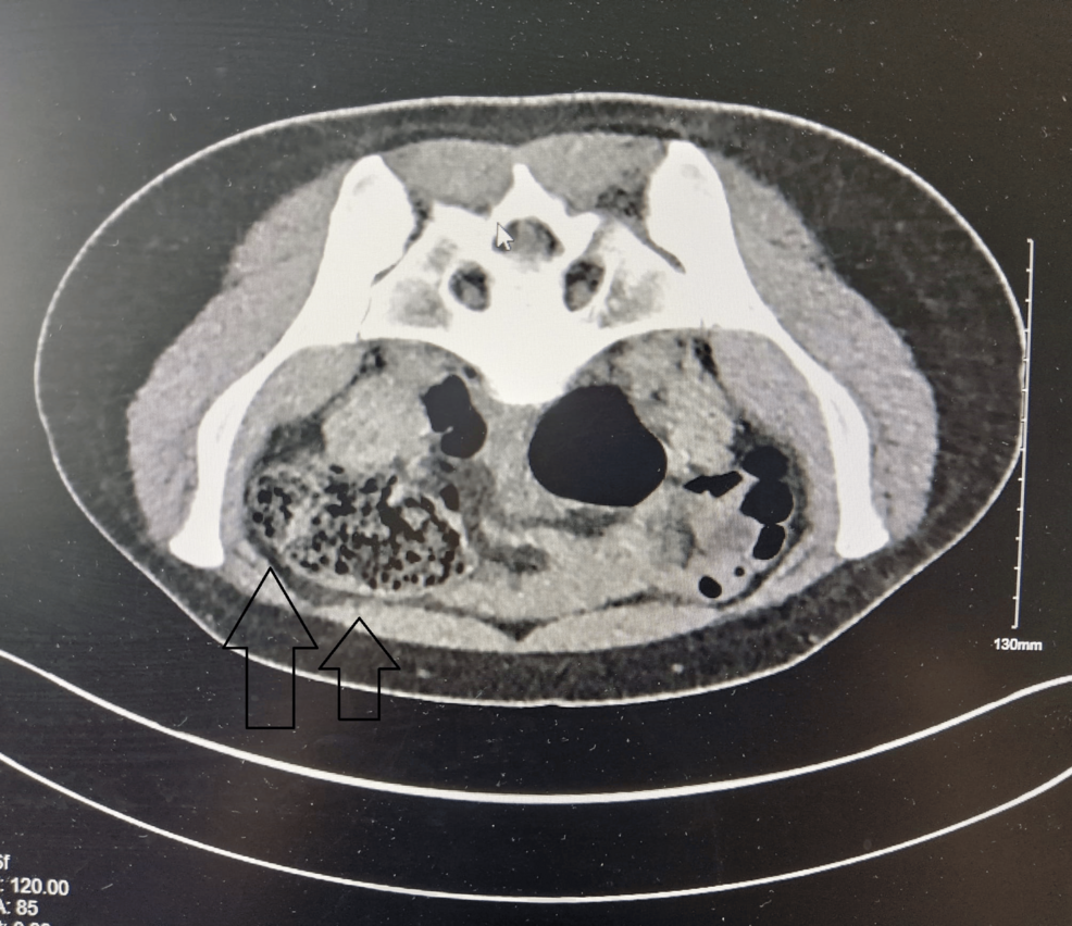 Twisted Right Fallopian Tube With a Large Fimbrial Cyst: A Diagnostic Challenge in Acute Pelvic Pain