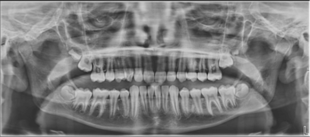A Paediatric Case of Sphenoid Sinusitis and Resultant Secondary Masticator Space Abscess Requiring Surgical Management