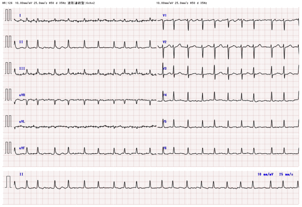 Successful Treatment of Pericardial Drainage and Platinum-Based Chemotherapy in a Case of BRCA-Positive Serous Peritoneal Carcinoma Complicated by Cardiac Tamponade