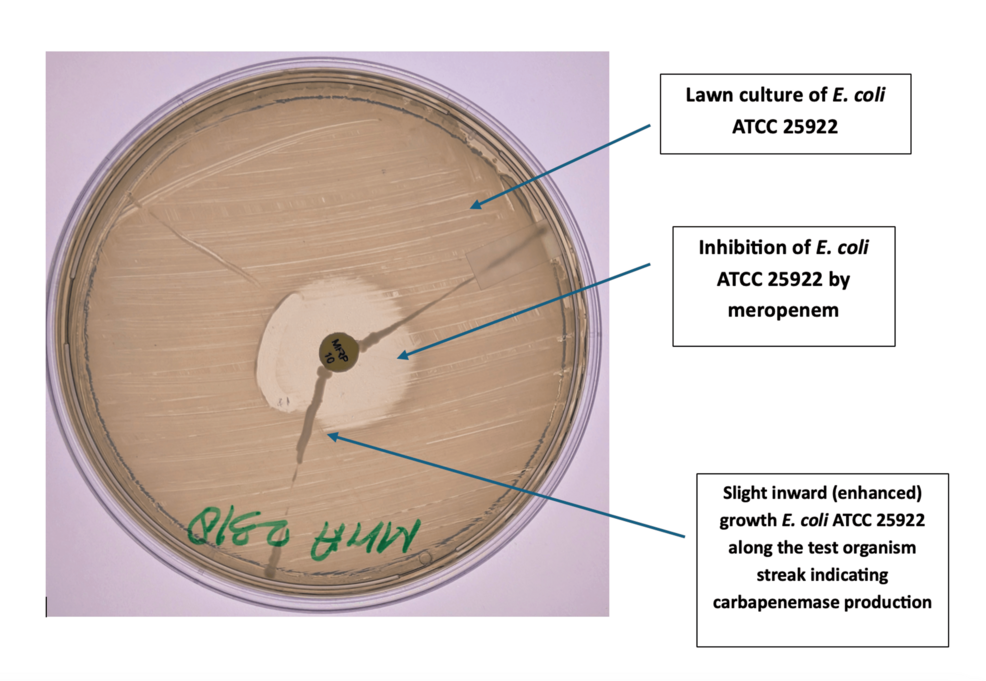 The Rising Menace: Carbapenem-Resistant Klebsiella pneumoniae in a Tertiary Care Center and Co-dominance of blaNDM, blaOXA-48 Along With the Emergence of blaVIM