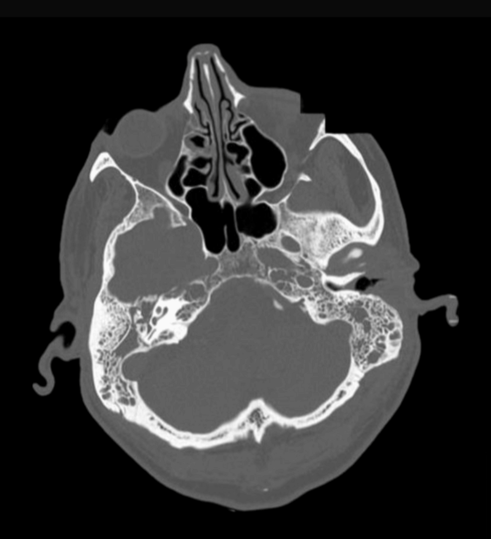 Type 2 Diabetes Mellitus With Complex Necrotizing Otitis Externa, Skull Base Osteomyelitis, and Cranial Nerve Palsies: A Case Report