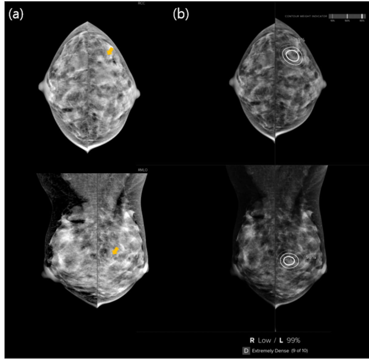 Mammography Study Shows Elevated Breast Cancer Risk with Concordance of Radiologist and AI Interpretation