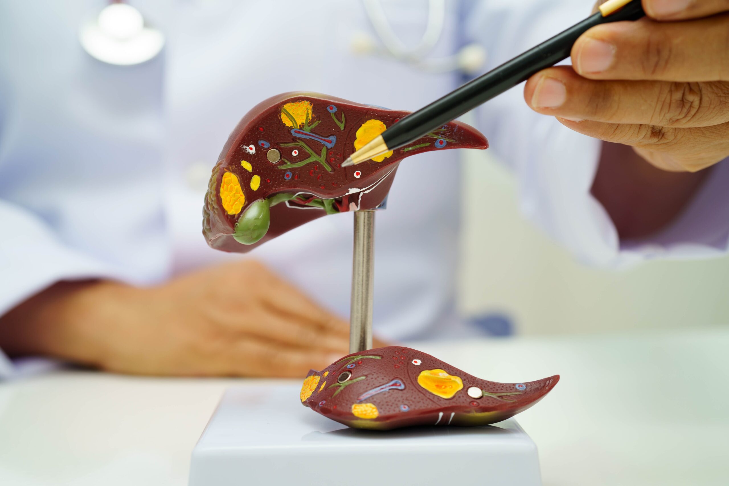 MASH, MASLD Linked to Higher Risk of Kidney Stones