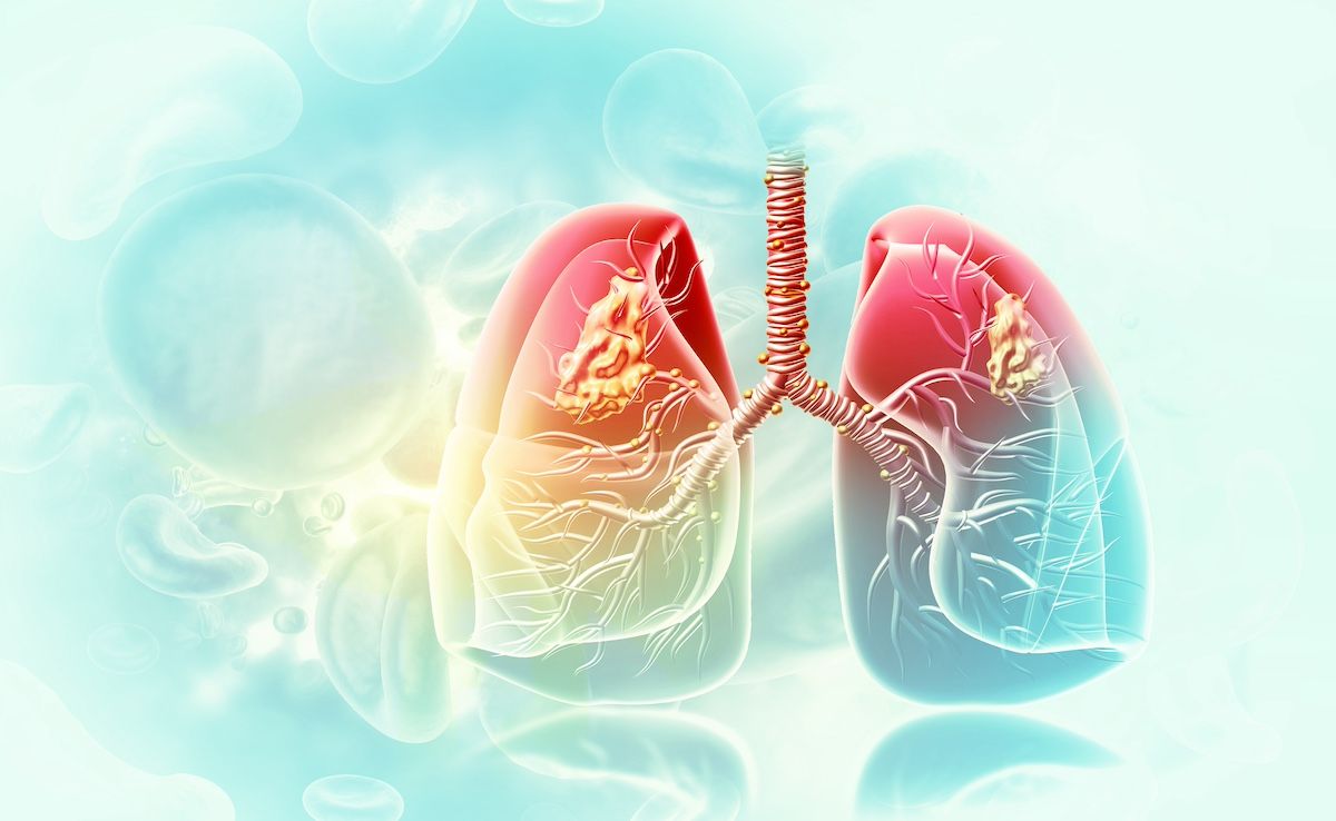 Real-World Outcomes From Third-Line SCLC Treatment Show Need for More Options