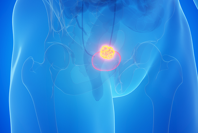 Mutations in normal cells may set stage for bladder cancer – UW Medicine