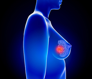 Gaps Persist in Follow-Up Care Among Young Survivors of Breast Cancer
