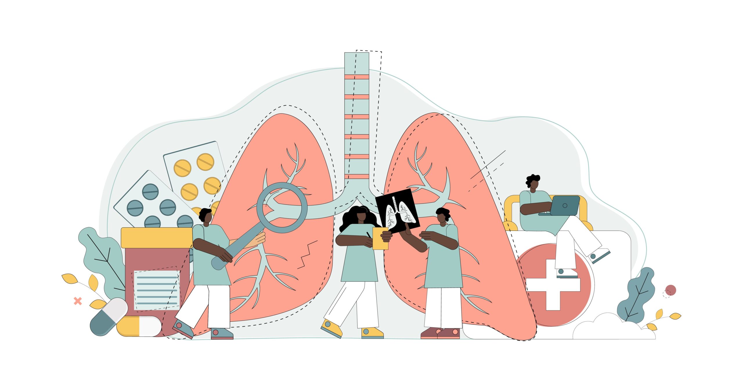 Brensocatib Reduced Symptom Burden, Neutrophil Serine Proteases Activity in Bronchiectasis