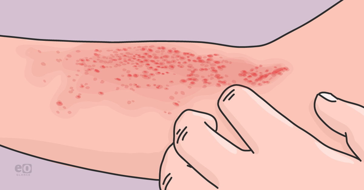 Atopic dermatitis linked to increased risk for AMD