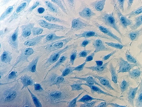 SLNB Alone vs Lymphadenectomy in Cervical Cancer