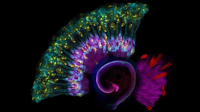 Mutations in CPD Gene Linked to Rare Congenital Hearing Loss