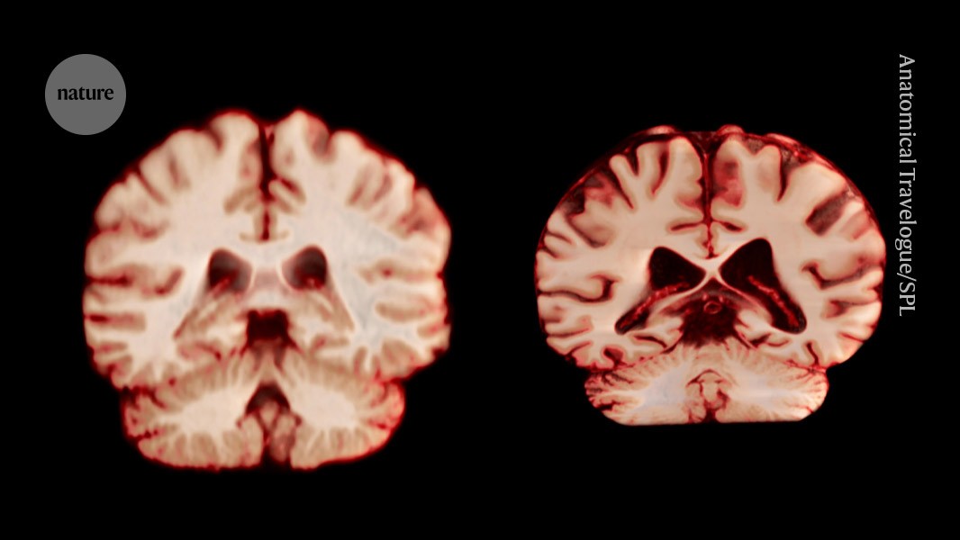 what that means for Alzheimer’s