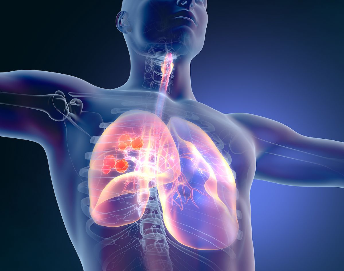 Sevabertinib Monotherapy Elicits Durable Responses in HER2-Mutant NSCLC