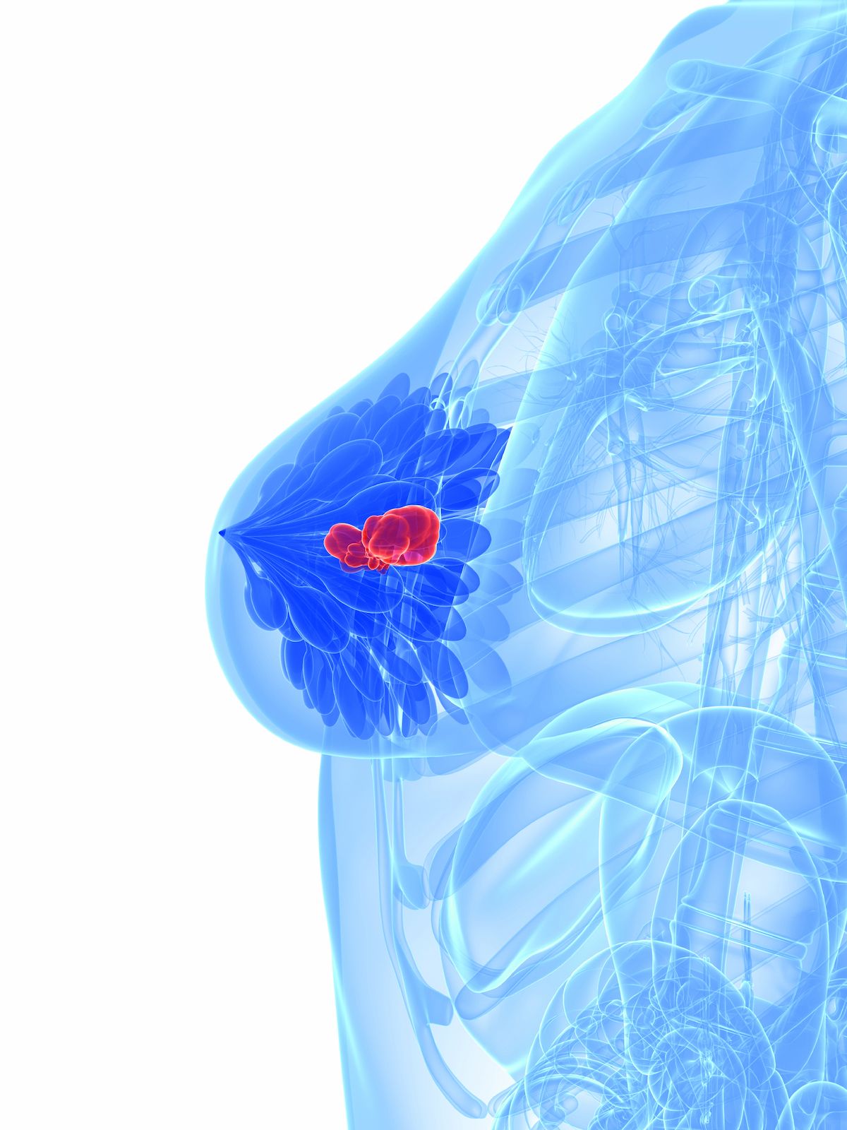 ASCENT-03 Trial Supports Standard Use of Sacituzumab Govitecan in mTNBC