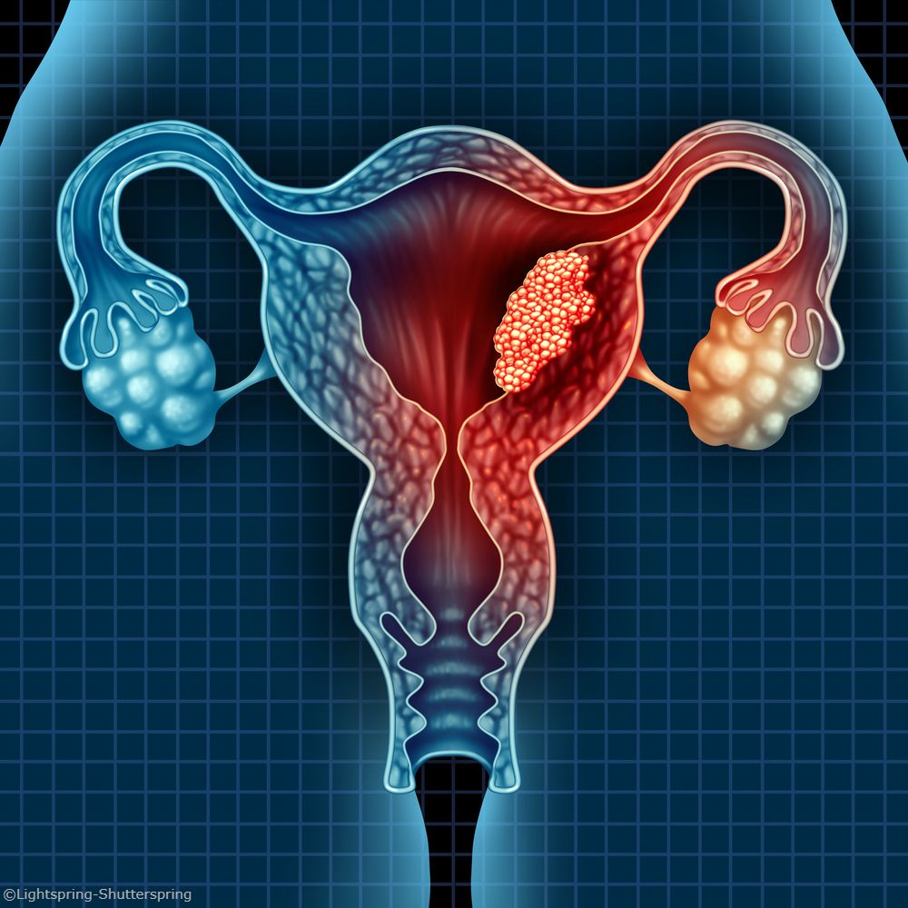 Atezolizumab Combo Displays Noninferior Survival in Endometrial Cancer