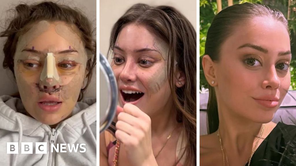 A facelift at 28? Why young people are turning to cosmetic surgery