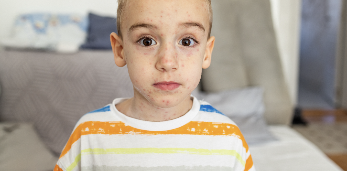 Can you get chickenpox twice? Or if you’re vaccinated? Experts answer 9 key questions
