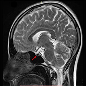 Hereditary Hemochromatosis Type 2A Presenting With Hypogonadism, Diabetes, and Osteoporosis in a Young Woman