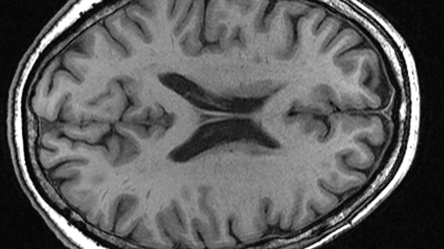 Blood test predicts how fast Parkinson’s will progress