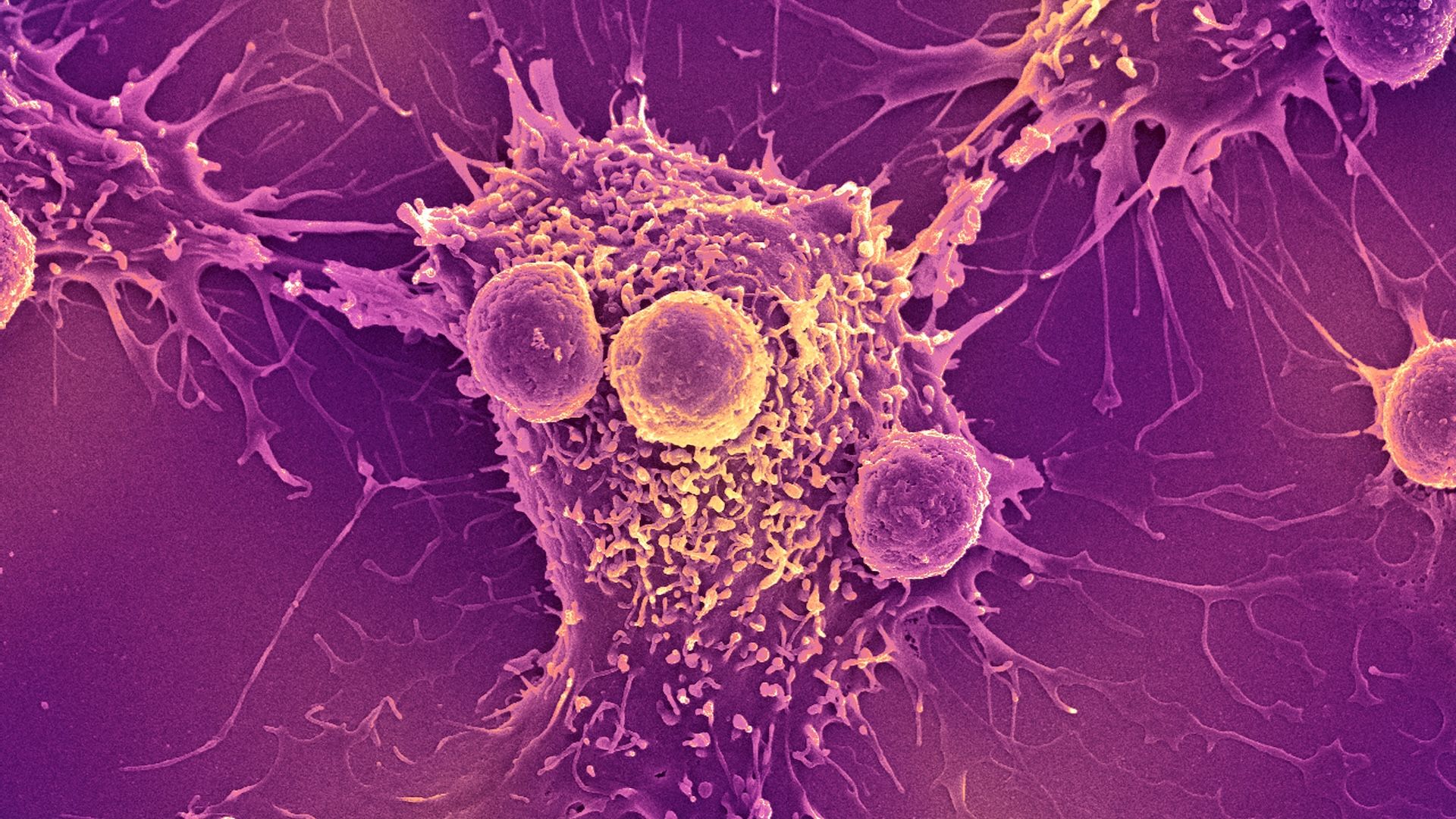 COVID-19 mRNA vaccines can trigger the immune system to recognize and kill cancer, research finds