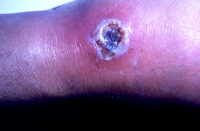 Peru reports cutaneous anthrax outbreak in Cañete