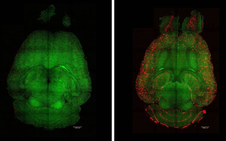 Nanoparticles reverse Alzheimer’s pathology in mice