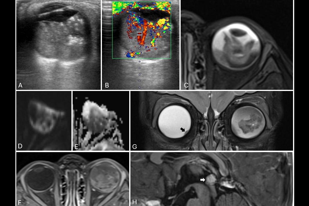 Imaging team shares 20 years of orbital ultrasound, MRI know-how