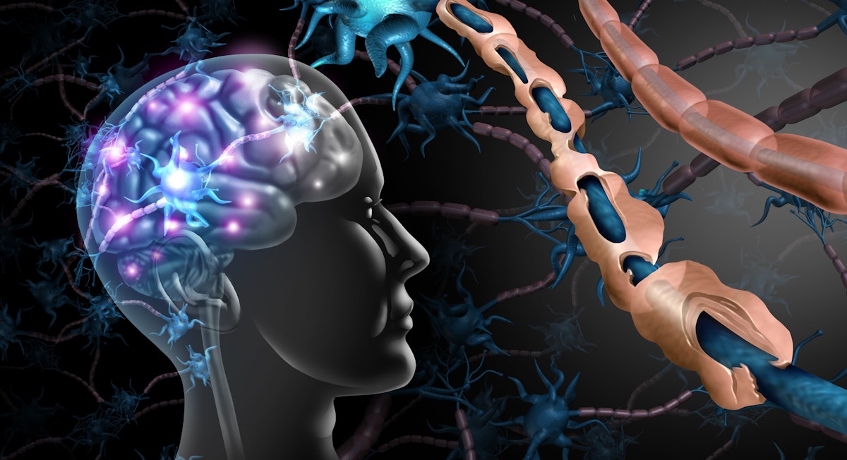 New MRI technique assesses brain changes in multiple sclerosis patients