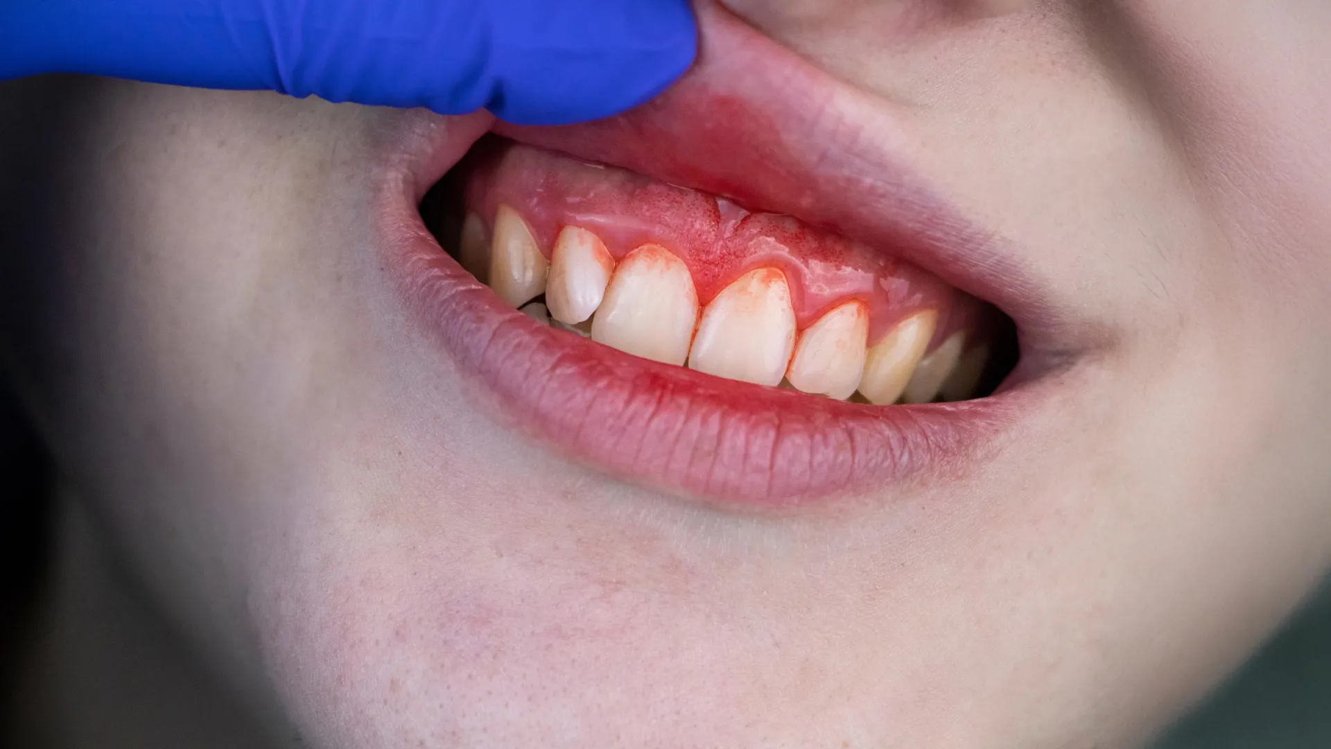 Gum disease may quietly damage the brain, scientists warn