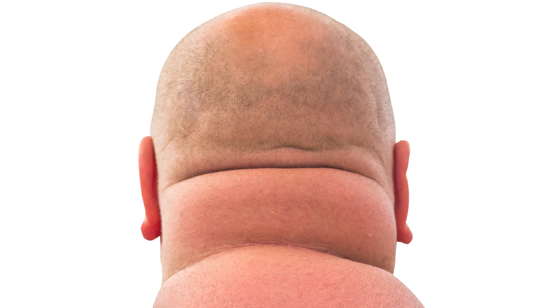 This simple neck measurement might reveal hidden heart risks
